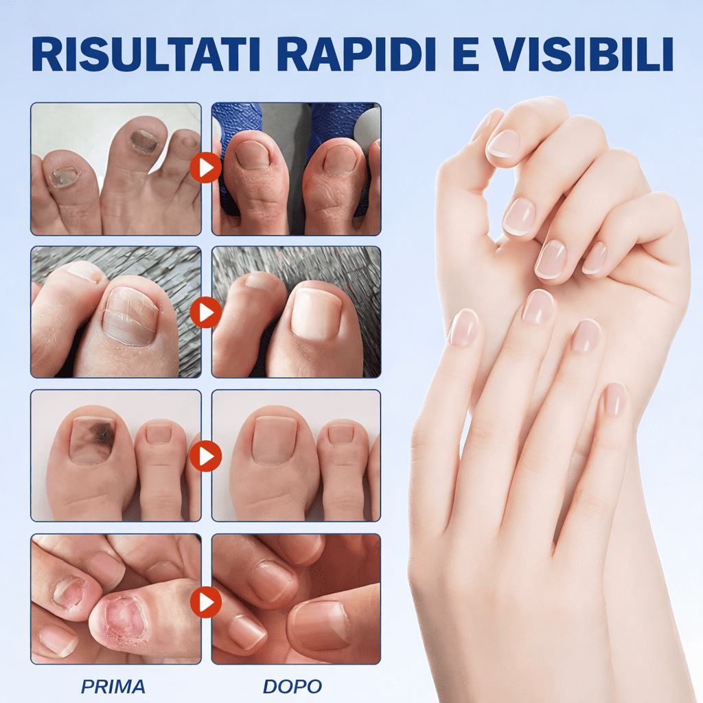 Cerotti Antifungini Per Unghie